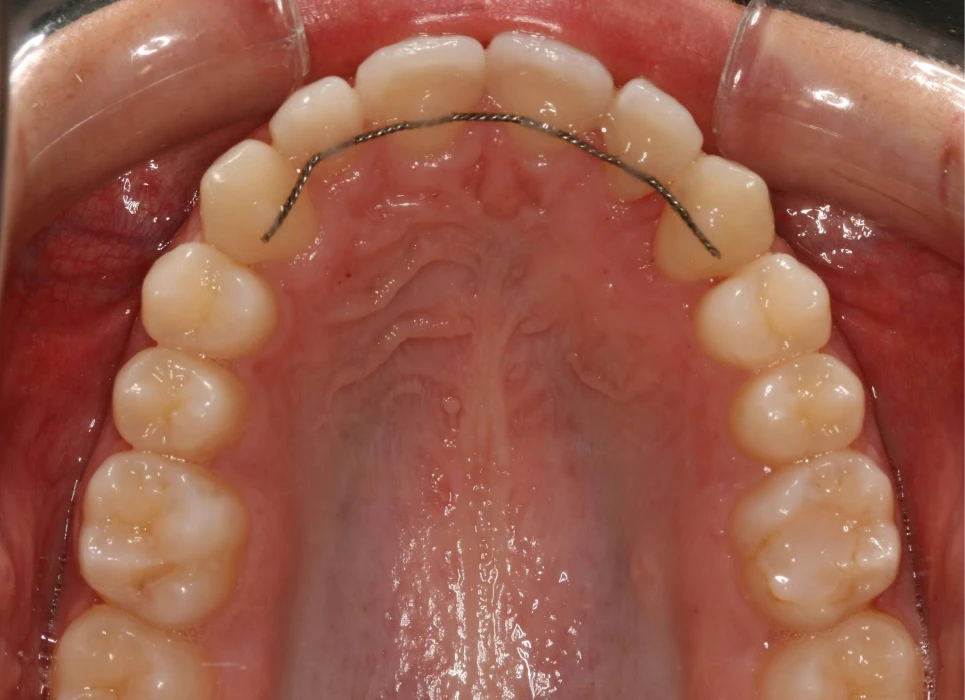 After image